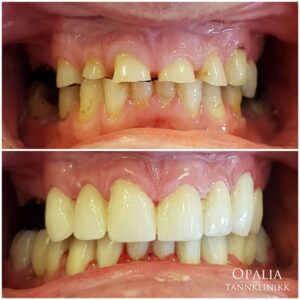Tannslitasje - tannlege og tannbehandling