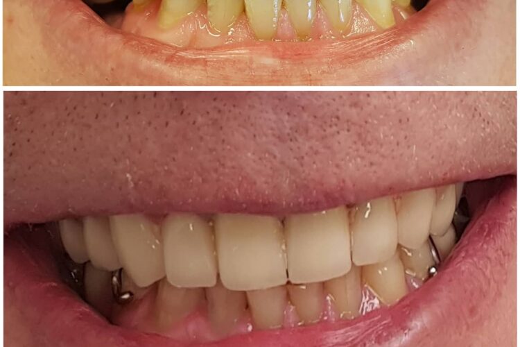 Tannslitasje - tannlege og tannbehandling