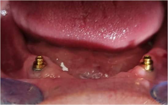 Trykknappfestene i munnen, som skal holde protesene på plass.